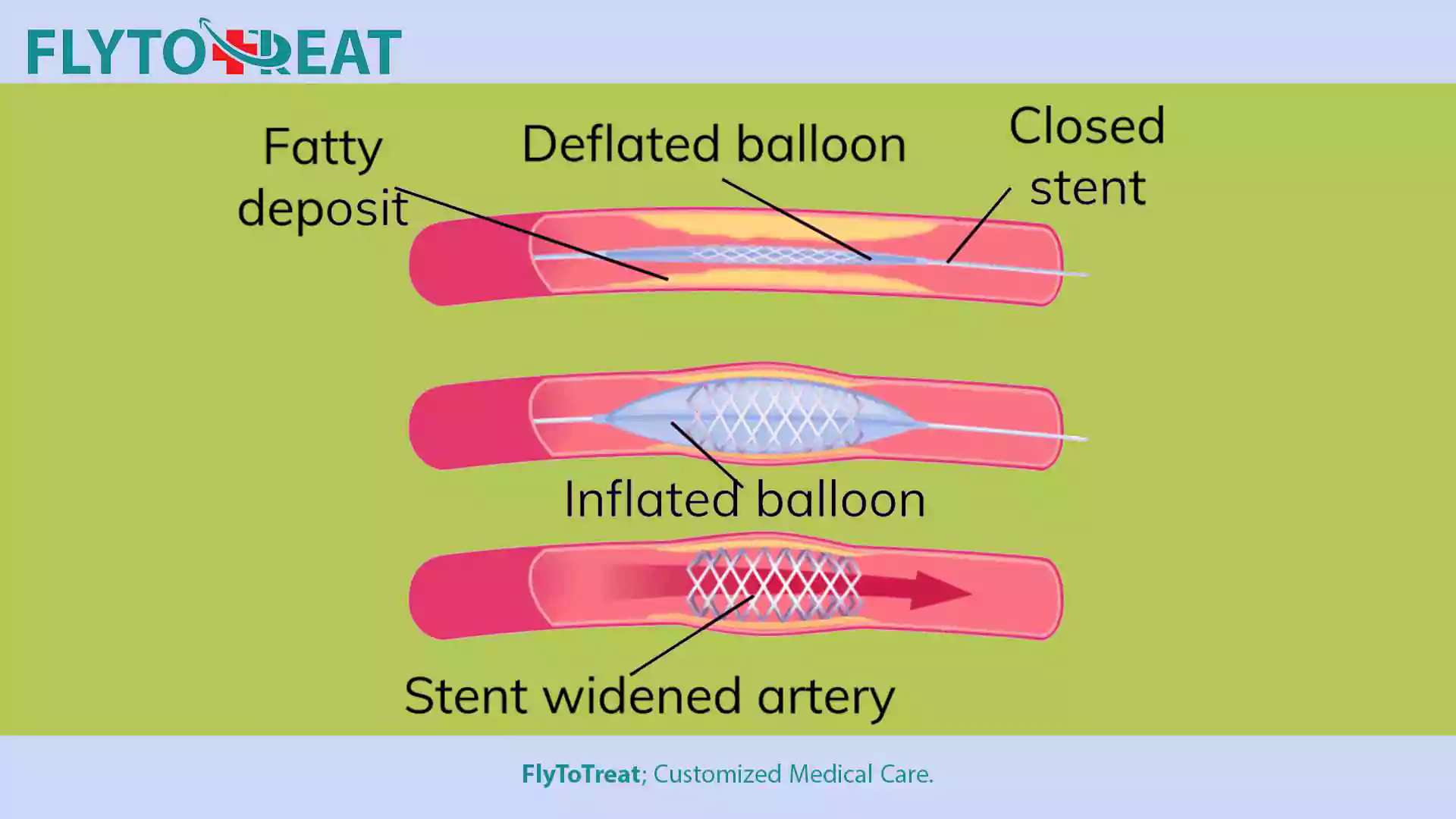 How Does an Angioplasty Procedure Work?