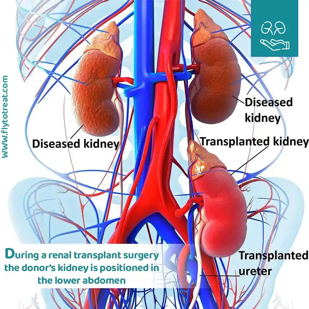 the donor’s kidney will be positioned in the lower abdomen