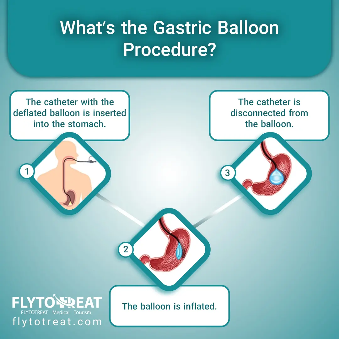 What's the gastric balloon procedure?